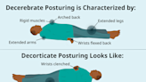 What Is Decorticate Posturing?