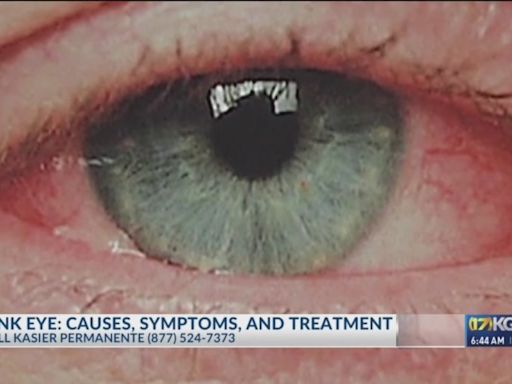 Pink Eye: Causes, symptoms and treatments