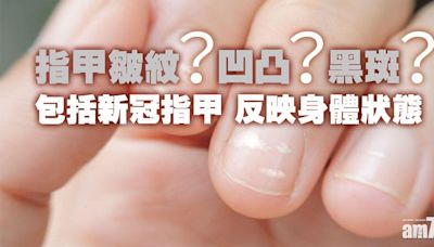 指甲直紋/橫紋/凹凸不平代表健康出問題？沒有月牙又代表乜？ | am730