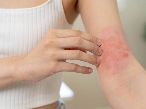 健康網》濕疹與「體內濕熱」有關！ 4皮膚問題中醫治療一次看 - 自由健康網