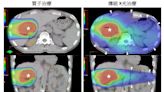 大型肝癌質子治療 存活期延逾2倍