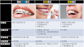 傳統牙套、隱形牙套哪個好？醫師解析 3 大牙齒矯正器優缺點