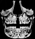 Deciduous teeth