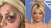 Bebe Rexha Shares Photo Update of Eye Injury After Onstage Assault: 'Black and Blue Now but Much Better'