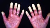 Raynaud’s Phenomenon: What to Know