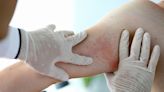 Dermatitis atópica: la enfermedad que afecta el rendimiento laboral y la interacción social y sigue siendo invisibilizada