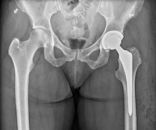 Hip replacement