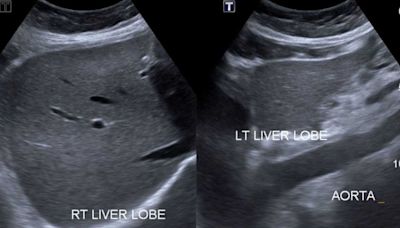 New US liver transplant policy raises cost and equity concerns, according to new study