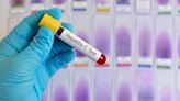 La OMS precalifica el primer test de autodiagnóstico para el virus de la hepatitis C