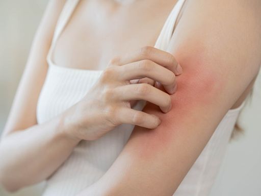 皮膚癢常見7原因 醫：小心是腎臟病警訊 - 健康