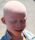 Albinism in humans