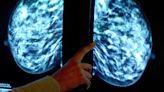 ‘Lives will be cut short’ if drug not given to women with breast cancer