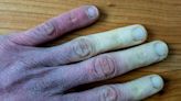 Victorian illness which causes pins and needles could be sign of more serious condition