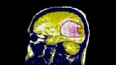 In two early trials, blood cancer treatment appears promising for deadly brain tumor