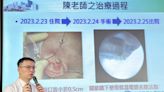 美女教師一張口就「咔咔響」 中國附醫採「顳顎關節鏡手術」治療復原快