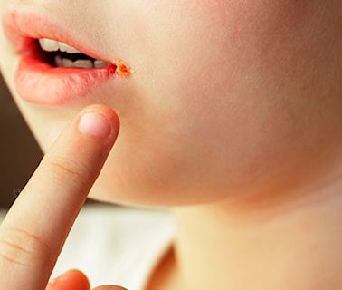 口周炎︳11歲女持續「敏感」2個月紅腫/搔癢/發炎 揭病因+附5個改善建議 ︳張傑醫生 | 健康百科