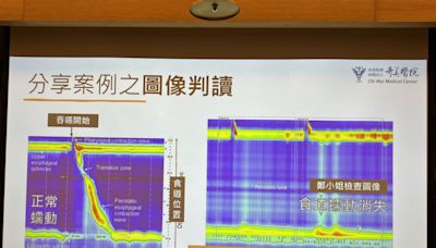 女罹硬皮症胃食道逆流 精準檢查驚見「食道罷工」 - 自由健康網