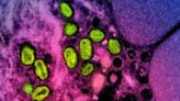 EUA alertam para retorno de versão mais mortal da mpox