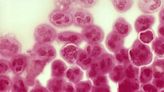 Sex disease gonorrhoea cases rocket in Cornwall