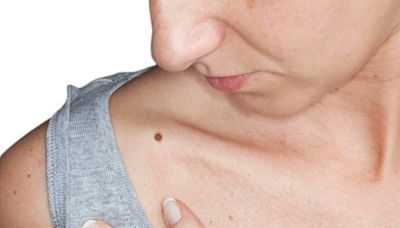 El melanoma es responsable del 75% de las muertes por cáncer de piel