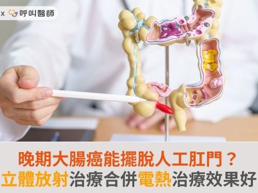 晚期大腸癌能擺脫人工肛門？立體放射治療合併電熱治療效果好 | 蕃新聞