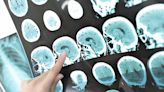 How doctors say you can identify when someone is having a stroke
