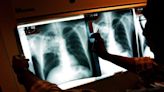California tuberculosis outbreak kills 1, infects 14 as officials declare health emergency