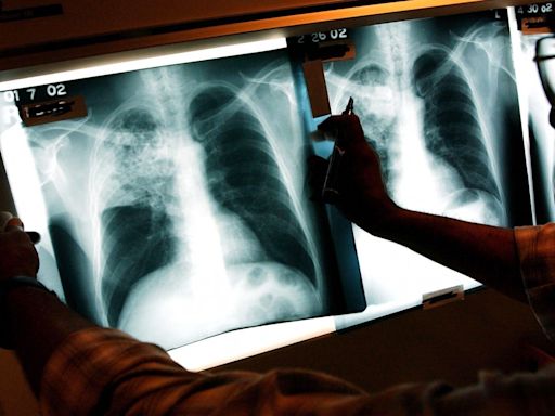 Tuberculosis in California: Outbreak declared in Long Beach, 1 dead, 9 hospitalized