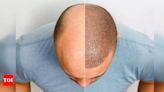 Does age matter for hair re-growth post hair transplant? | - Times of India