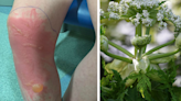 North east teen spends four nights in hospital after brush with toxic plant