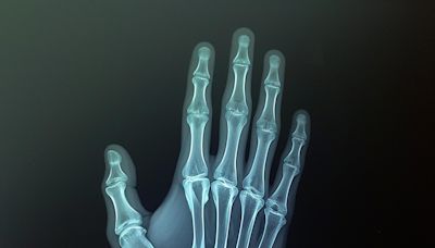 Study provides guidelines to doctors for individual treatment of wrist fractures