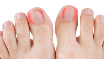 10 Effective Remedies for Toenail Fungus That Could Save Your Nail - WV MetroNews