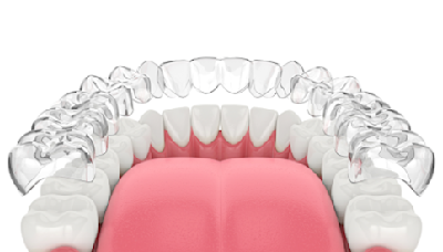 How Does Invisalign Work Step by Step?