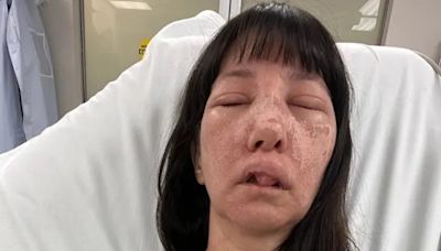 "Skin Is On Fire": US Woman Suffers Horrific Injuries After Being Bitten By Deadly Spiders