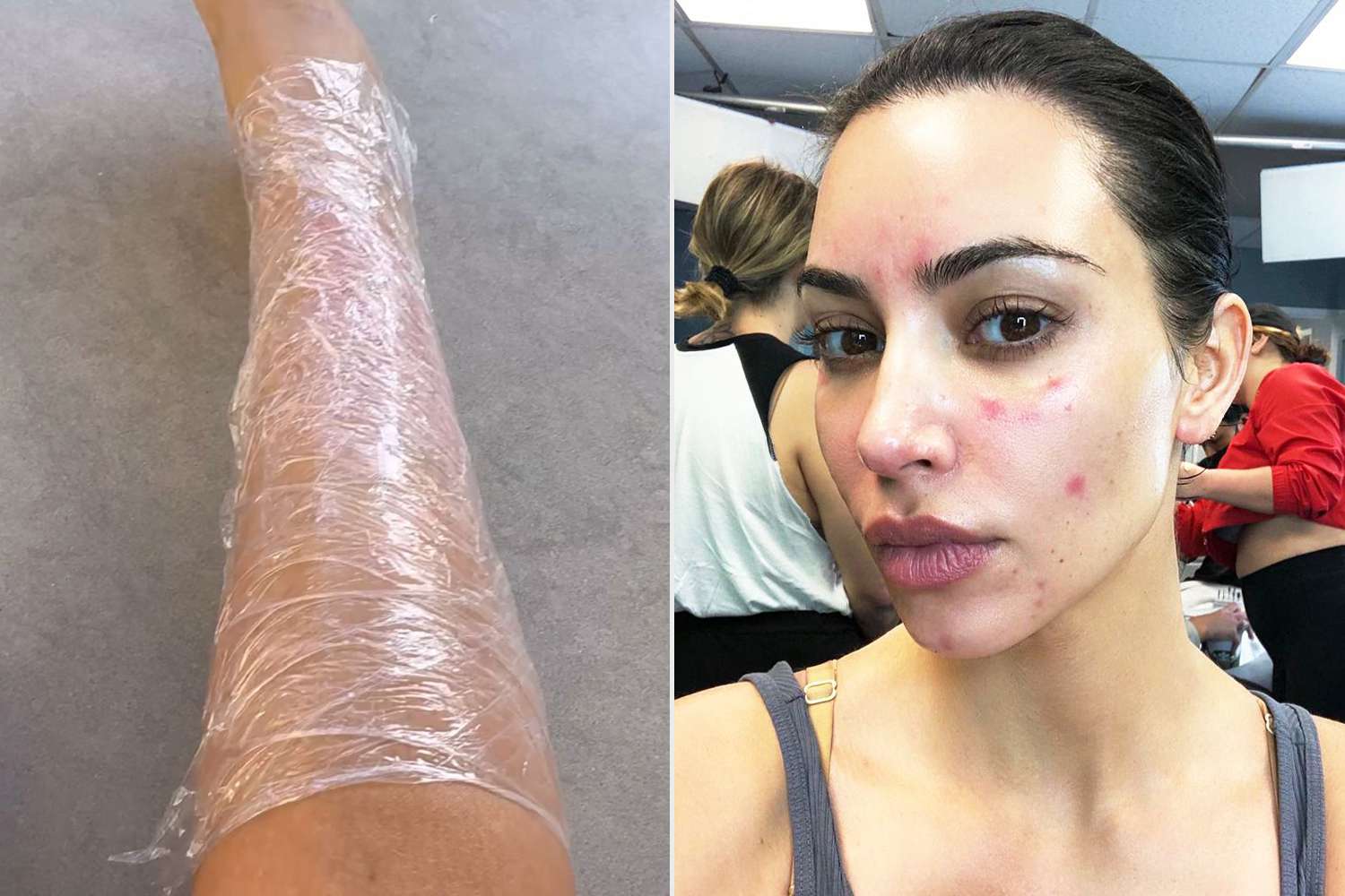 Kim Kardashian Slept in Saran Wrap for Psoriasis Relief: 'Sounded Like the Tin Man'