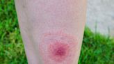 Warning issued over infected insect bites as cases surge