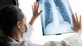 More Adults Should Be Screened for Lung Cancer Under New Guidelines from the American Cancer Society