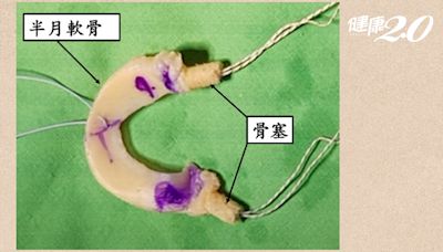 膝蓋痛怎麼辦？膝蓋卡卡能治療嗎？半月板受損用異體移植 避免提早換關節