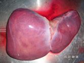 Liver transplantation