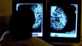 Avance científico podría evitar la “bomba de tiempo” del cáncer de mama