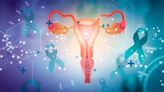 La endometriosis se relaciona con probabilidades cuatro veces más altas de cáncer de ovario