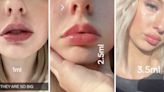 ‘Watch me get addicted to lip filler’ TikTok trend is raising concerns with beauty experts
