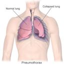 Pneumothorax