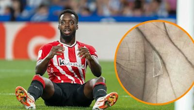 Iñaki Williams ha jugado dos años con un cristal en la planta de un pie