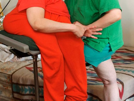 Oldest living conjoined twins, Lori and George Schappell, die at 62