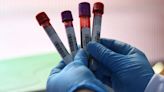 El análisis de sangre para detectar cáncer de colon que está en pruebas en EEUU: “Podría detectar el cáncer de colon antes de que se propague”