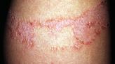 What Is Contact Dermatitis?