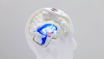 Lumière sur la maladie de Parkinson : un dispositif implanté dans la tête du patient !