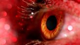 Study identifies factors associated with hydroxychloroquine retinopathy