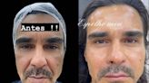 André Gonçalves faz harmonização facial; veja antes e depois